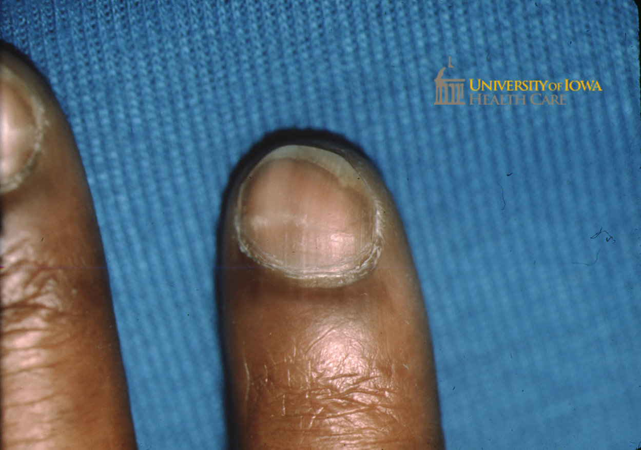 Transverse groove of the fingernail. (click images for higher resolution).